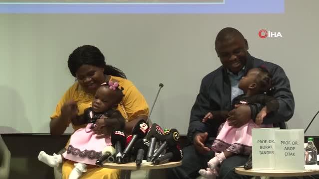 Kamerunlu yapışık ikizler Türkiye'de yeniden doğdu