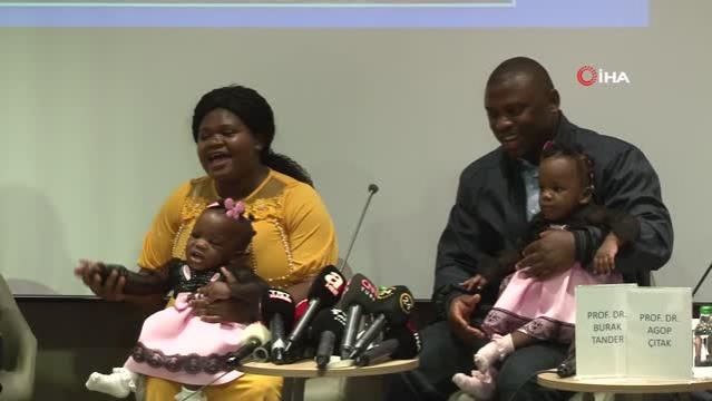 Kamerunlu yapışık ikizler Türkiye'de yeniden doğdu
